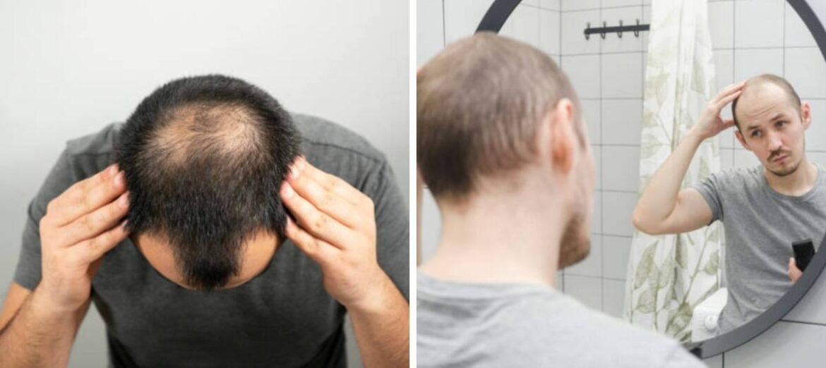 La calvicie no es solo genética: estas son las principales razones por las que se le puede estar cayendo el cabello